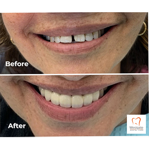 Close up of smile before and after getting a dental bridge in Arlington Heights