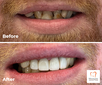 Smile before and after dental crowns on upper teeth and gum recontouring