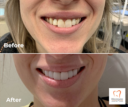 Smile before and after getting new dental crowns