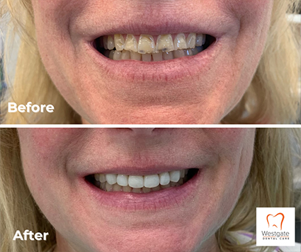 Smile before and after getting new dental crowns on upper arch