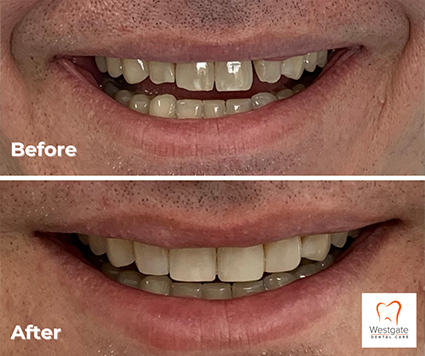Close up of grin before and after smile makeover