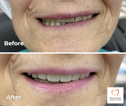 Close up of grin before and after new upper dental crowns