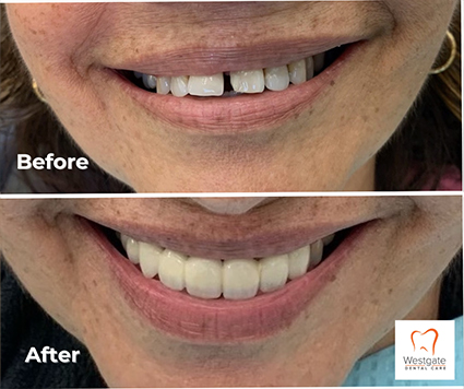 Close up of smile before and after upper dental bridge