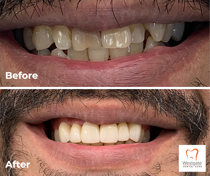 Close up of smile before and after upper dental crowns