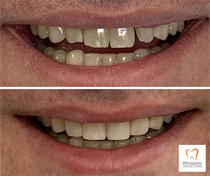 Close up of smile before and after upper dental crowns