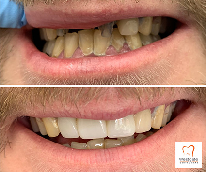 Close up of smile before and after upper dental crowns