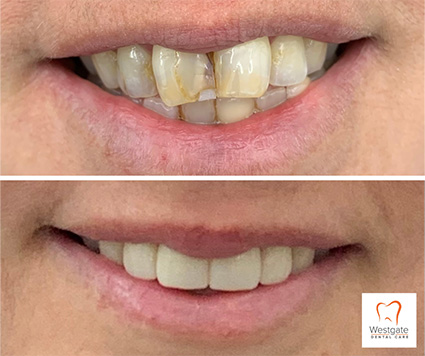 Close up of smile before and after upper dental crowns