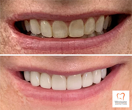 Close up of smile before and after upper dental crowns