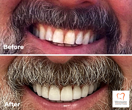 Smile before and after gum recontouring and dental crowns on upper teeth