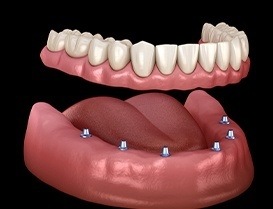 Illustration of full denture being fitted onto six dental implants in lower jaw
