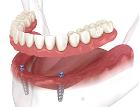 Illustrated denture being placed onto two dental implants