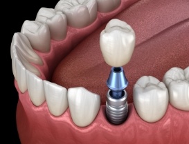 Illustrated dental crown being placed onto a dental implant