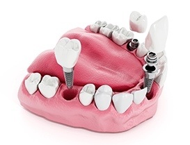 Illustration of several dental implants with crowns being placed in the mouth