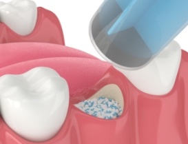 Illustrated bone grafting material being placed in jawbone after tooth extraction