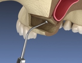 Illustrated sinus being lifted with thin metal rod