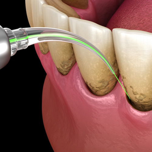 Digital image of a dental laser treating plaque accumulation