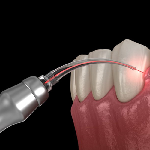 Digital image of a dental laser addressing swollen gum tissue