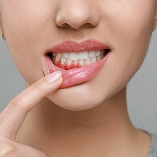 Woman pulling down her bottom lip to show infected gums