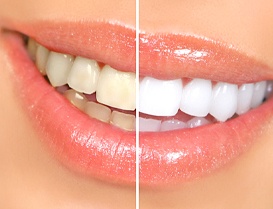 Close up of someone smiling before and after teeth whitening