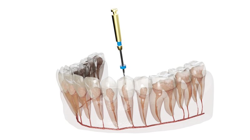 digital image of a root canal